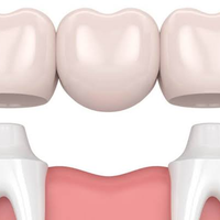 Crown and Bridges dental illustration