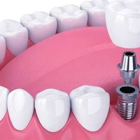 Dental Implants procedure illustration