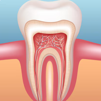 Root Canal Treatment illustration